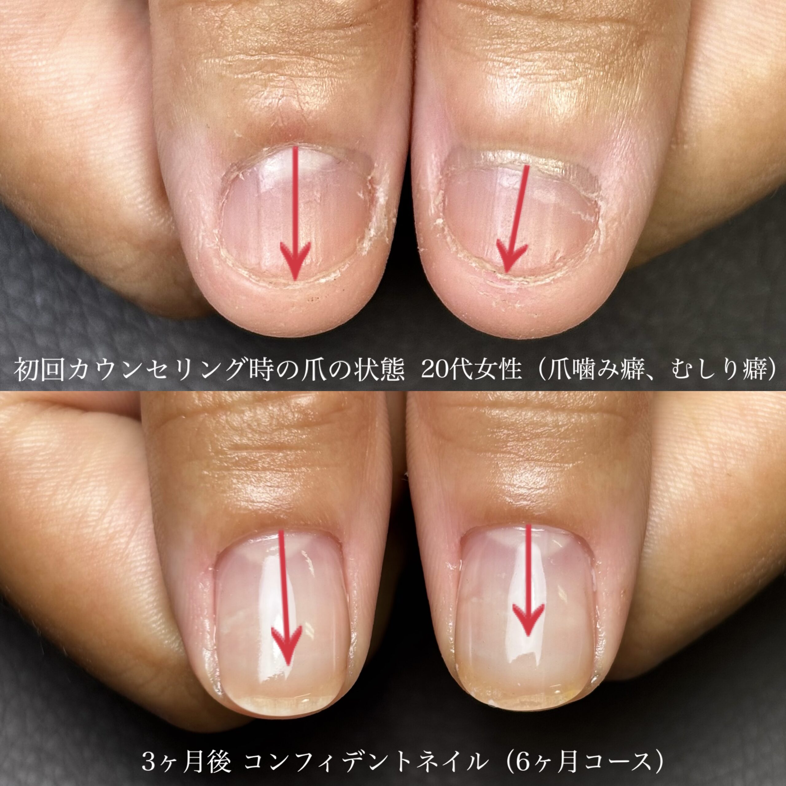 深爪矯正のビフォーアフター