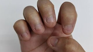 【20代女性・食品関係勤務】爪噛み癖・むしり癖による深爪が劇的変化｜施術実績：藤枝市 ネイルサロン