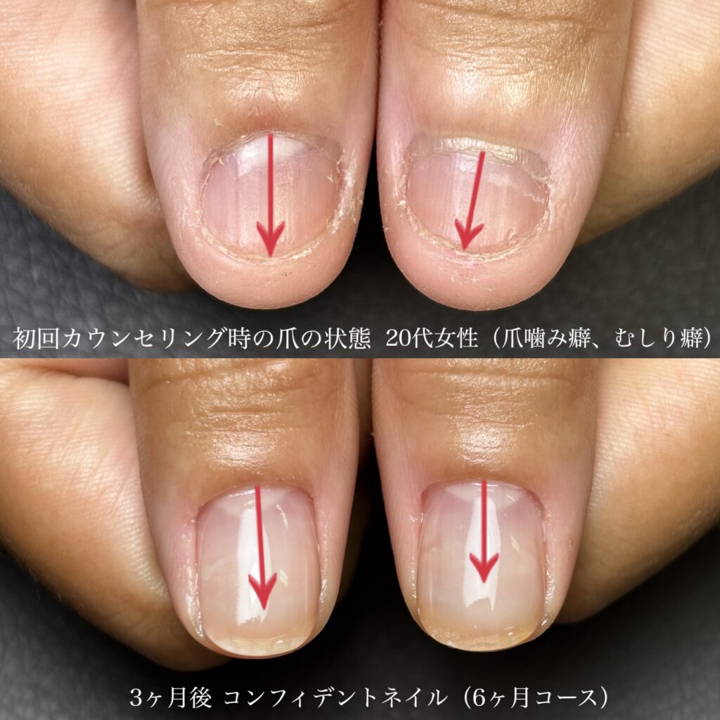 深爪矯正ビフォーアフター