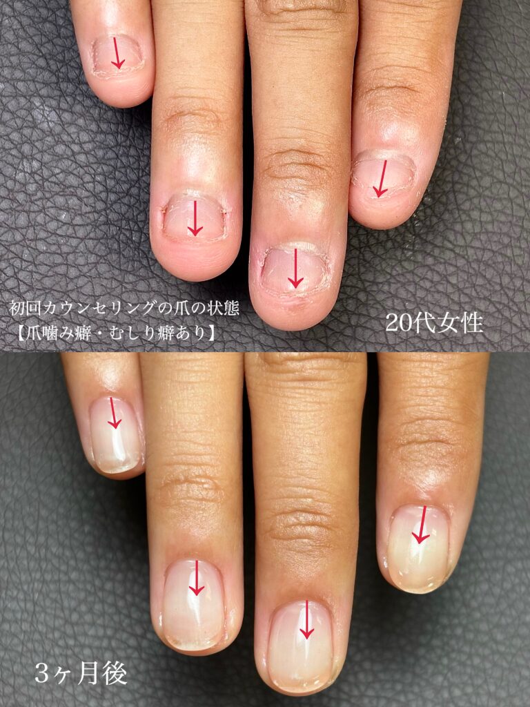 深爪矯正ビフォーアフター比較写真 藤枝市ネイルサロンAtelier ENNe