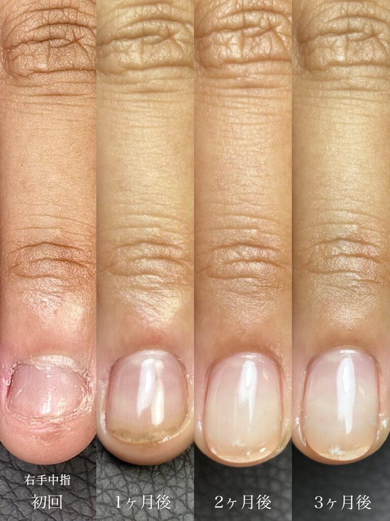 深爪矯正3ヶ月までの経過写真 噛み癖改善途中経過