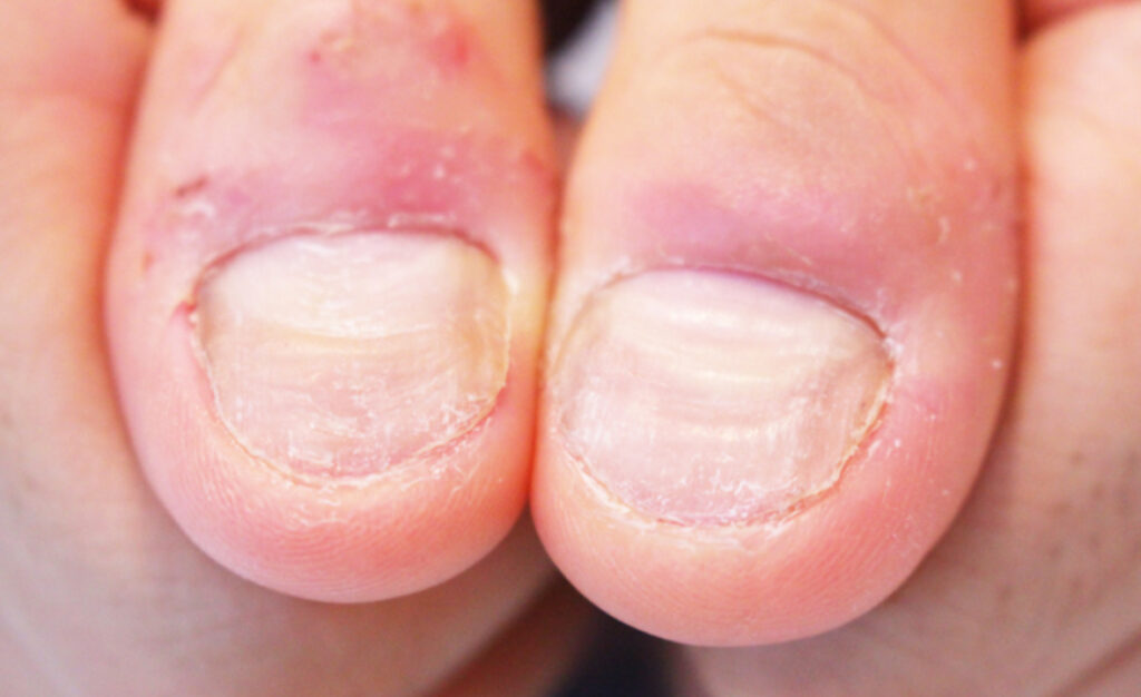 深爪改善したい|静岡