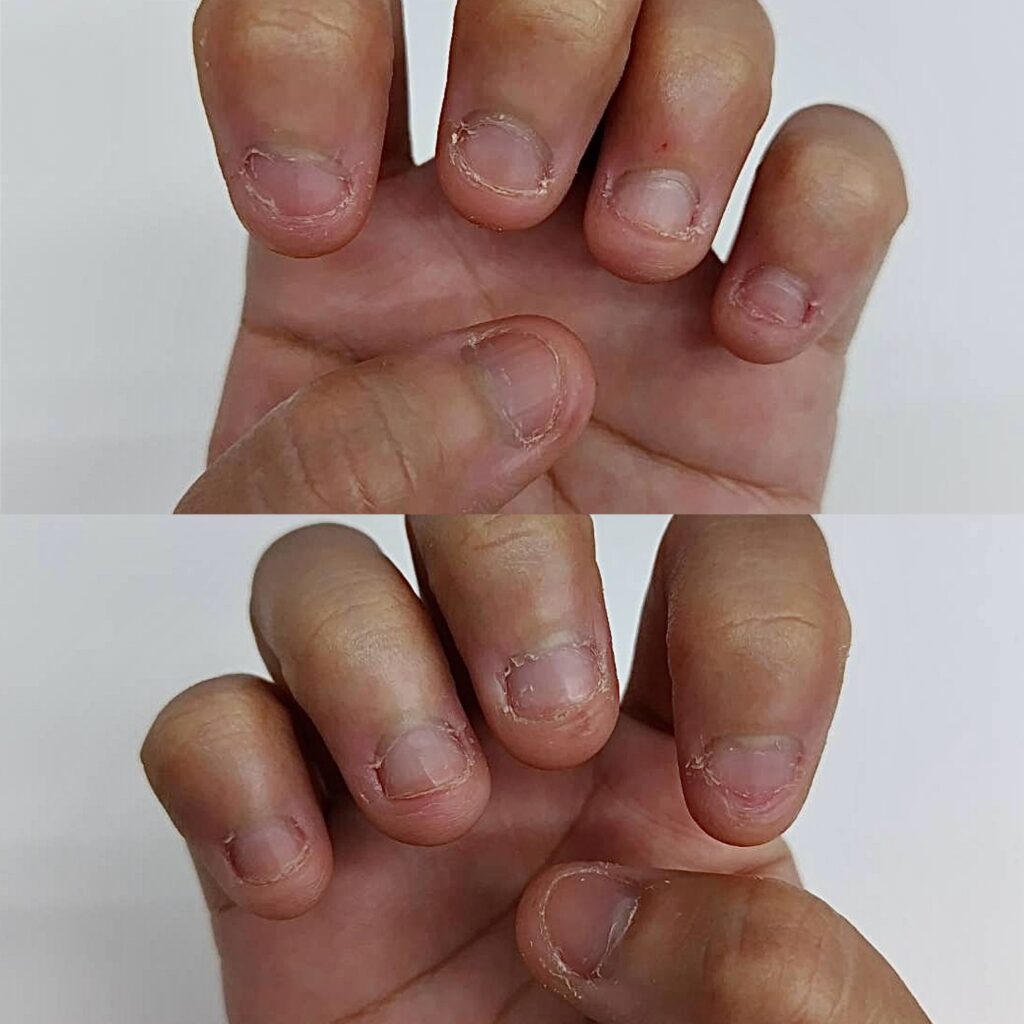 噛み癖による深爪のビフォー写真（20代食品関係、女性・藤枝市）