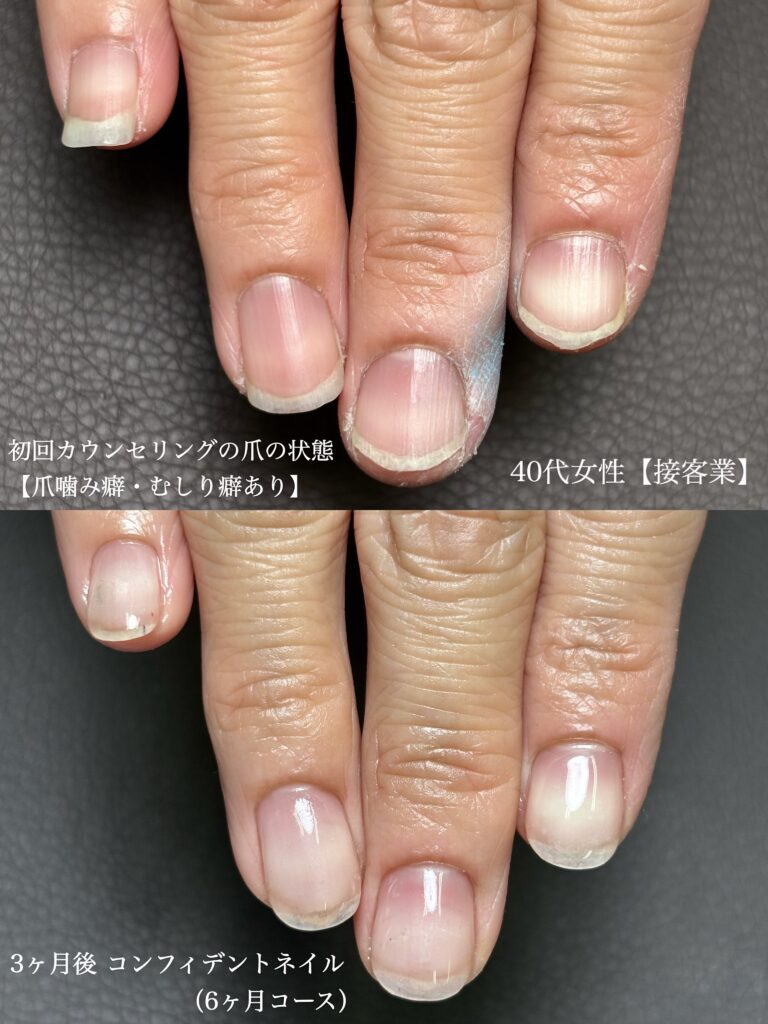 深爪矯正経過写真 噛み癖改善 静岡県