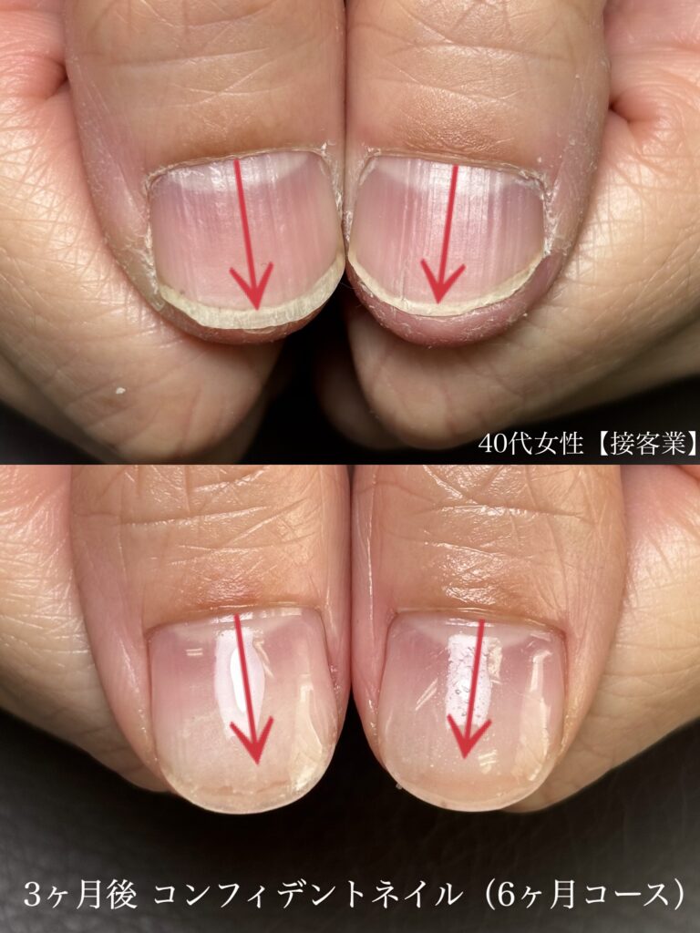 深爪矯正ビフォーアフター比較 静岡県藤枝市