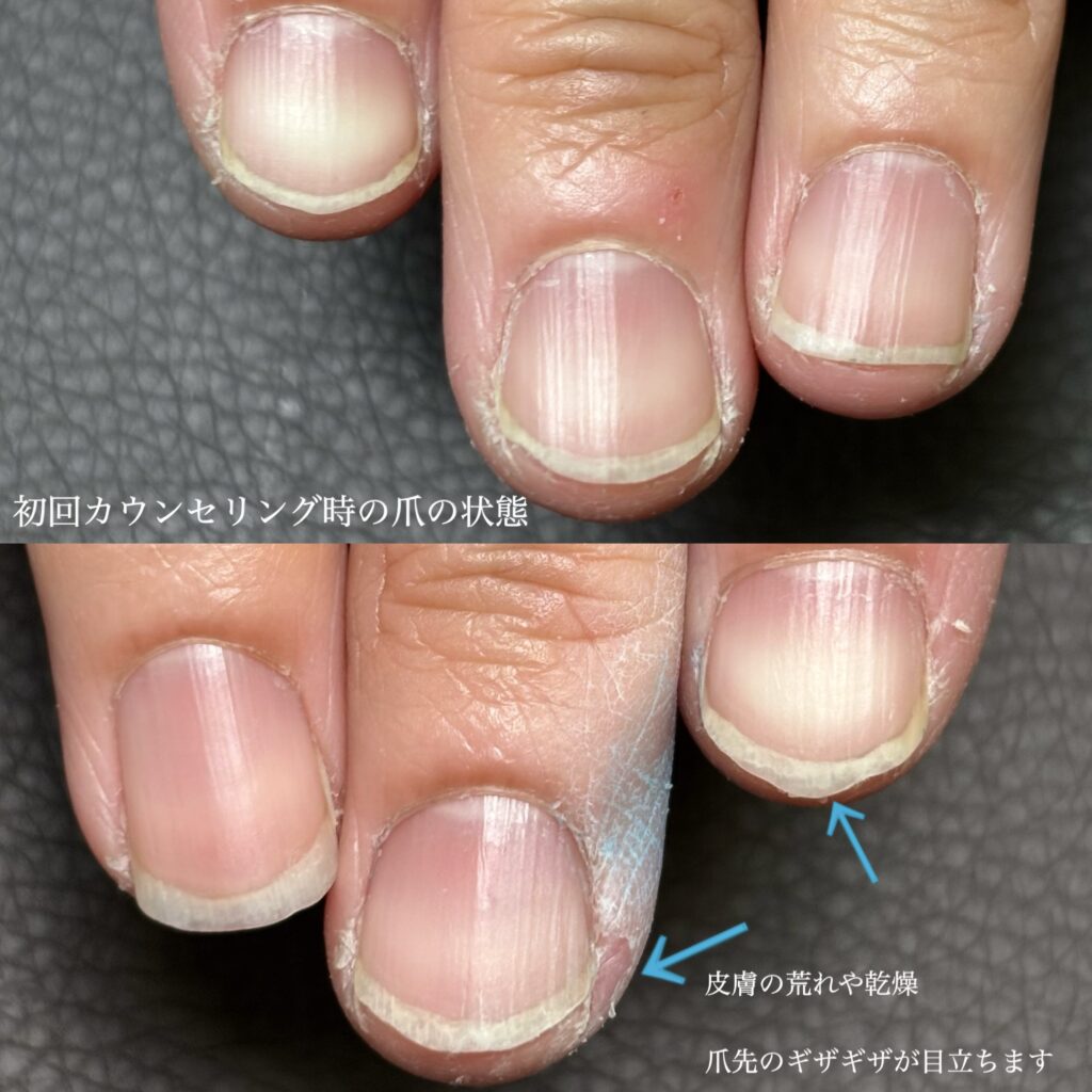 噛み癖,むしり癖による施術前写真 40代女性 静岡県