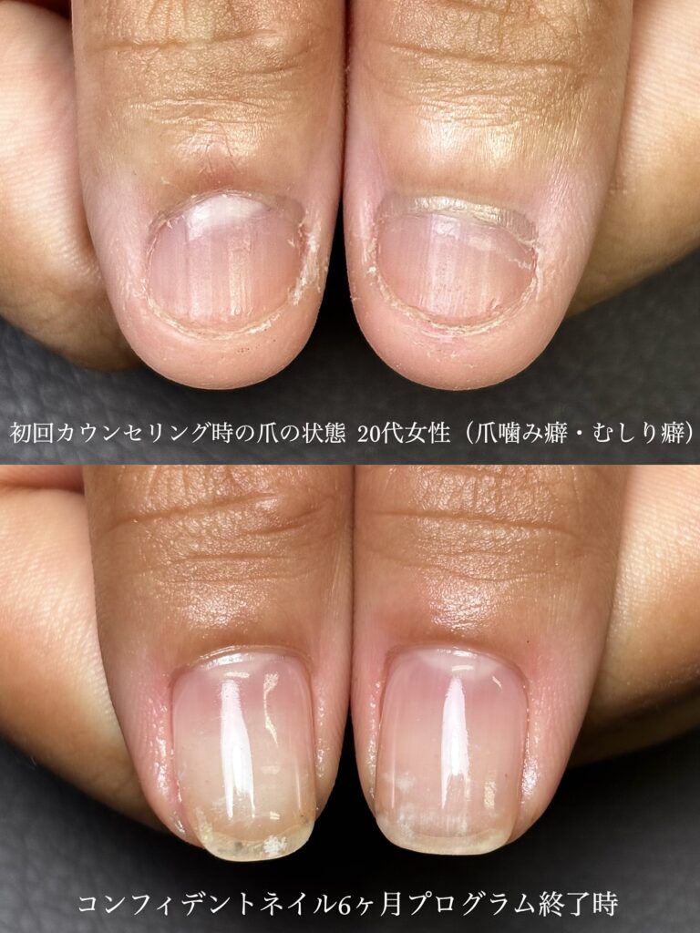 静岡県藤枝市の爪噛み癖改善サロン