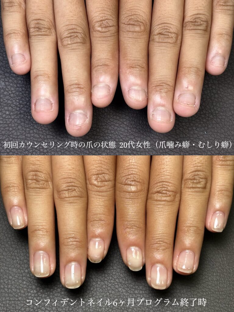 静岡県深爪改善