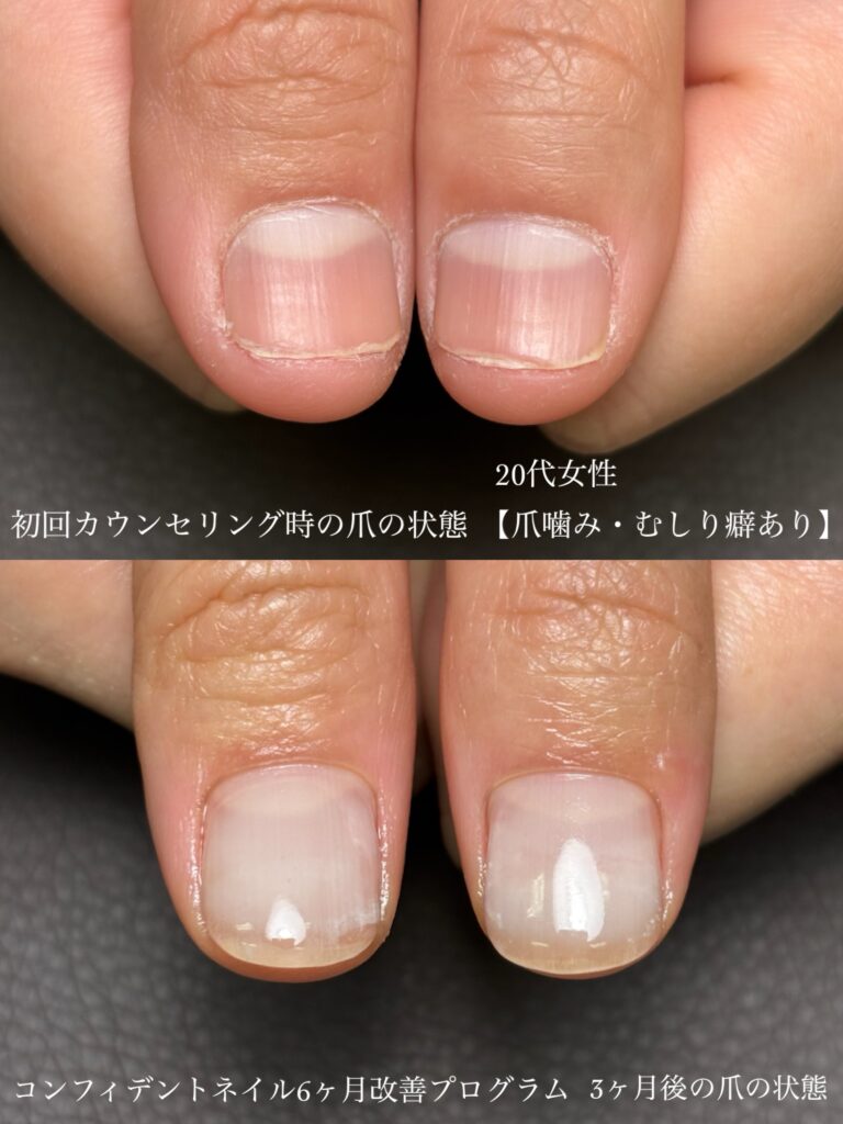 男爪に悩んでいた看護師さんの深爪改善3ヶ月経過