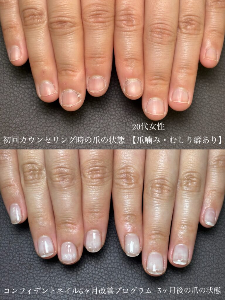 男爪に悩んでいた看護師さんの深爪改善3ヶ月経過