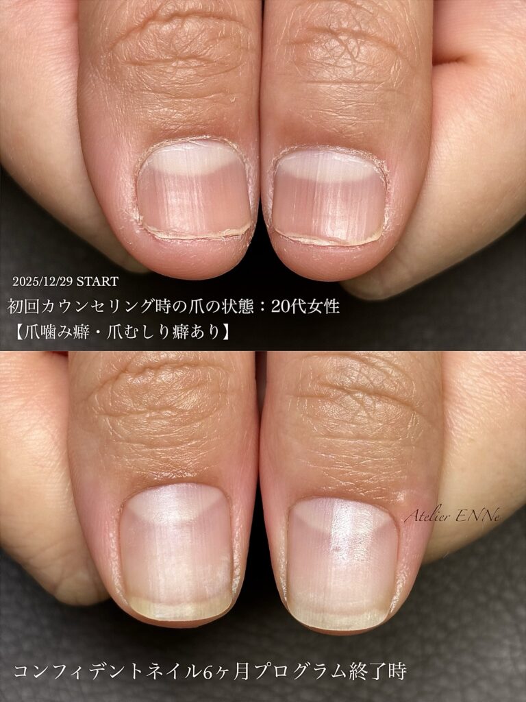 焼津市の深爪改善卒業後の自然な自爪