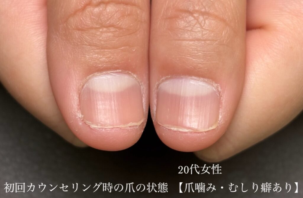 焼津市の20代看護師さんの初回カウンセリング時の写真