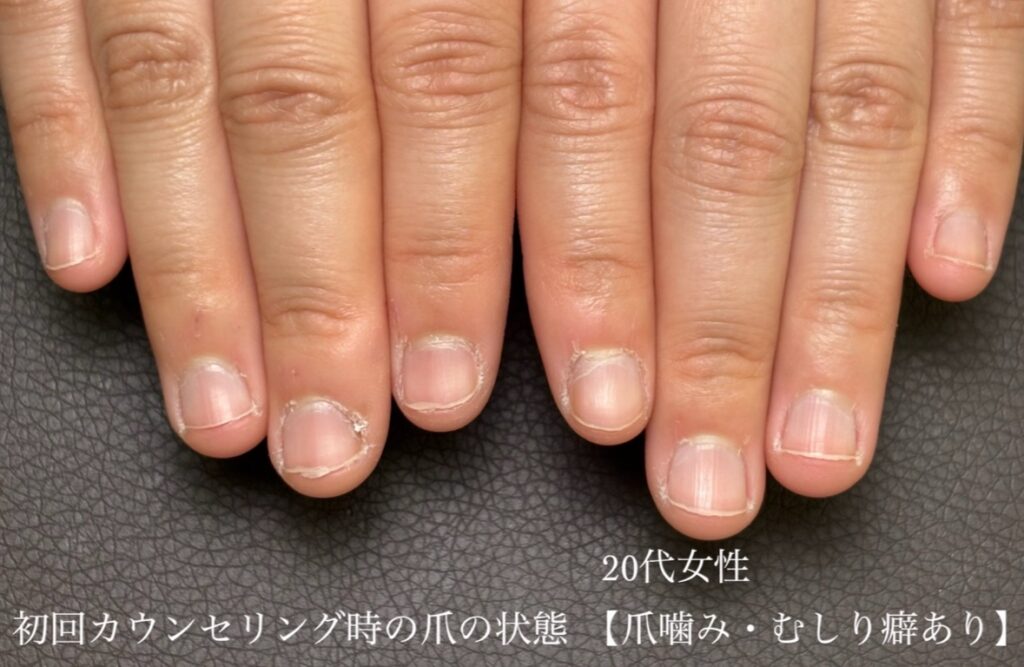 焼津市の20代看護師さんの深爪・爪噛み改善 初回来店時